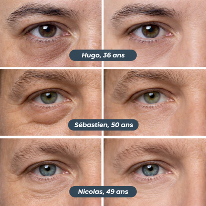 SKYNLUXE™ – Patches Yeux Micro-Aiguilles Coréens